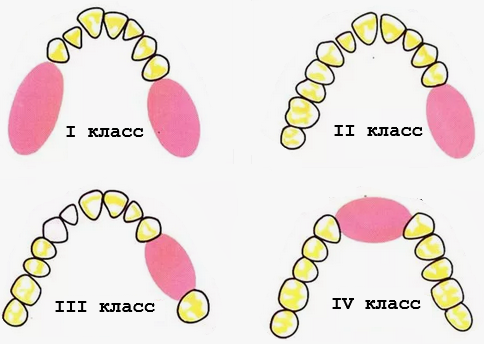 Дефекты зубных рядов. Классификация по Кеннеди, классификация по Гаврилову