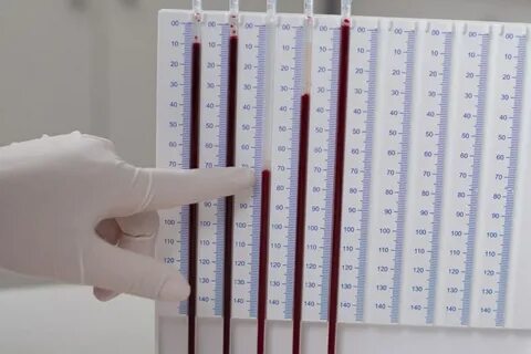 Что такое СОЭ? Определение СОЭ