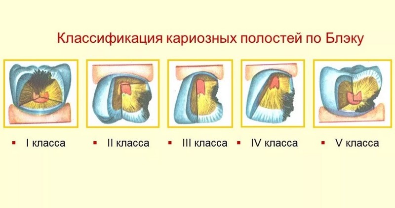 Классы по Блеку: расположение кариозных полостей, классификация кариеса