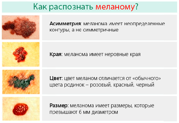 Признаки и симптомы меланомы