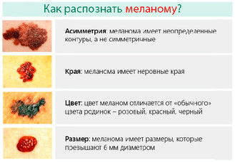 Признаки и симптомы меланомы