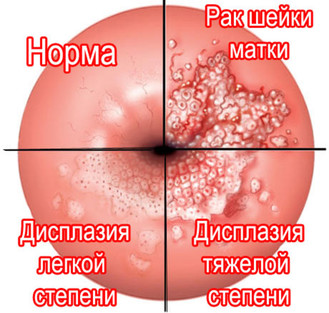Эрозия шейки матки Эрозия шейки матки