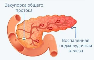 Панкреатит: симптомы и лечение