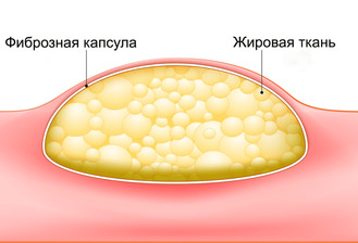 Липома - что это такое, опасно ли?