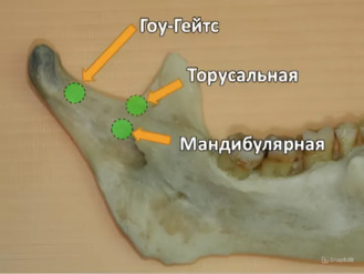 Анестезия на нижней челюсти, видео Анестезия на нижней челюсти, видео