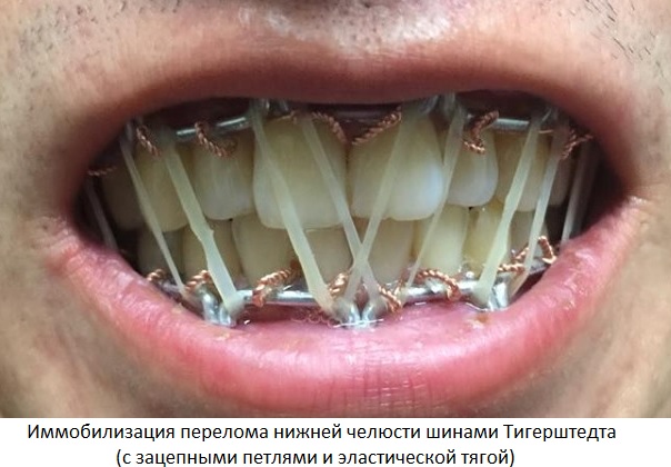 Что делать если сломали челюсть