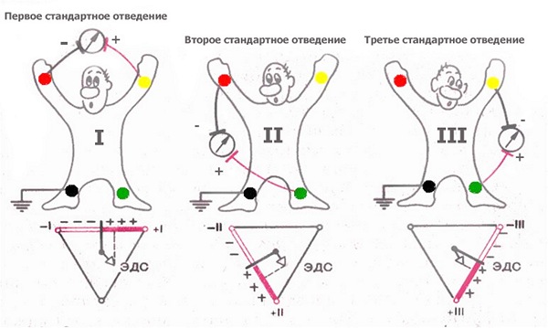 ЭКГ техника наложения электродов