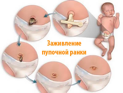 Правила обработки пупка новорожденного после выписки из роддома